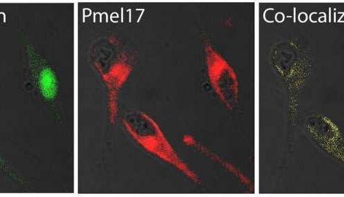 An amyloid link between Parkinson’s disease and melanoma