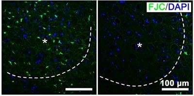 An illuminating possibility for stroke treatment: Nano-photosynthesis