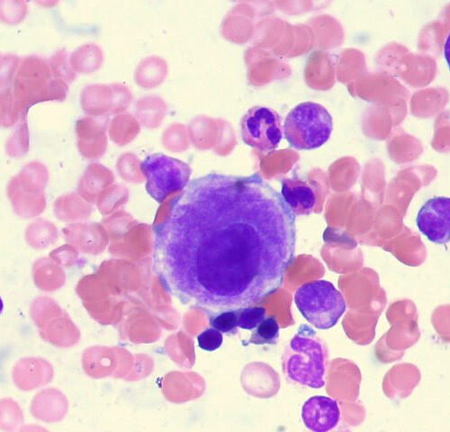 Researchers Develop First-in-Class Inhibitors Against Key Leukemia Protein