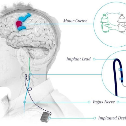 Surgical procedure may help restore hand and arm function after stroke