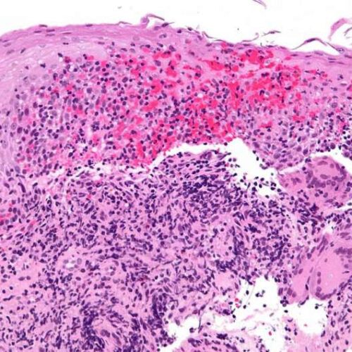 Crohn’s disease patients have specific IgG antibodies to human bacterial flagellins