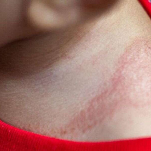 Drug could be promising new option against eczema