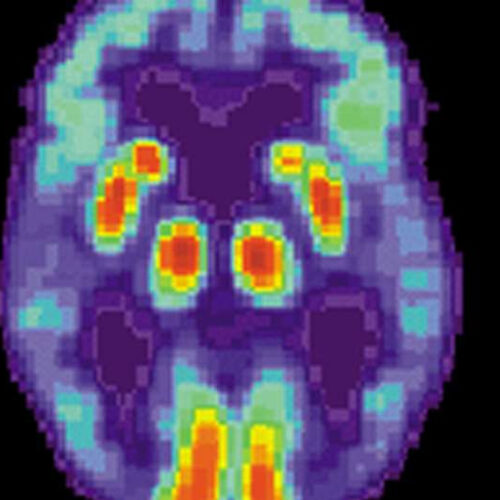 Gene therapy in Alzheimer’s disease mouse model preserves learning and memory