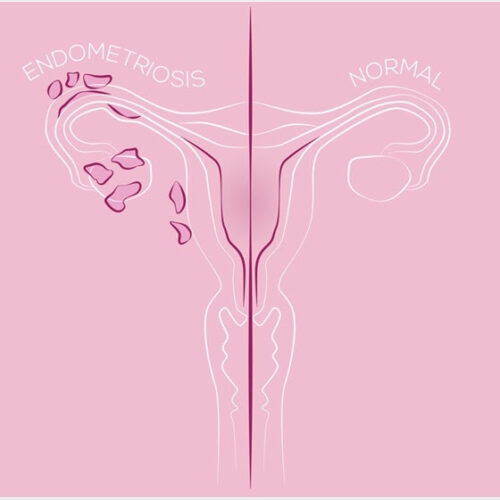 Missed or Delayed Diagnosis of Endometriosis