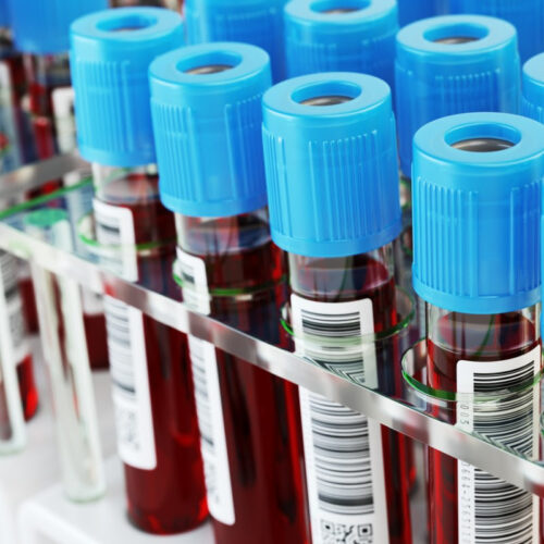 Massive blood sampling study identifies predictors of Alzheimer’s risk