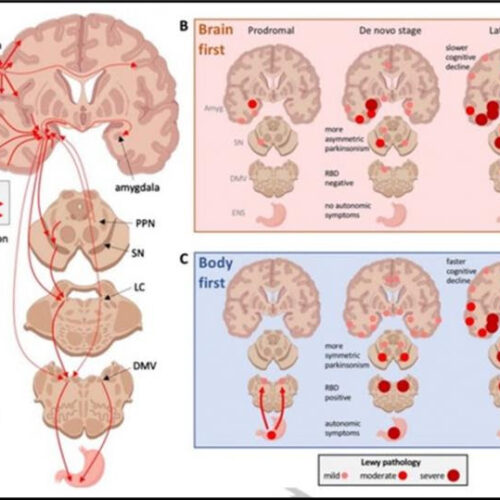 New model may explain the mystery of asymmetry in Parkinson’s disease