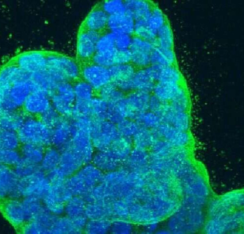 Spread of breast cancer linked to newly discovered RNA splicing mechanism