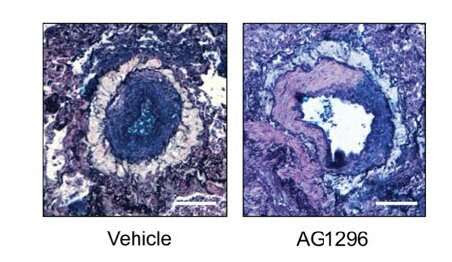 From 4500 possibilities, one compound emerges as promising treatment for PAH