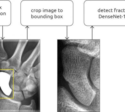 Researchers use AI to detect wrist fractures