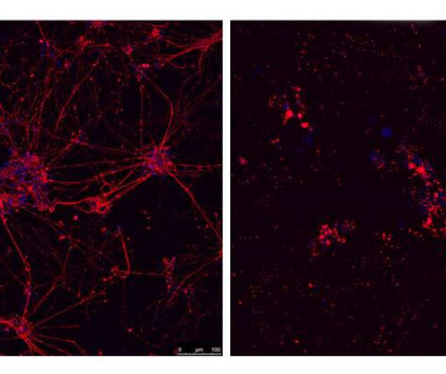 Researchers discover the cause of neuronal death in familial ALS patients