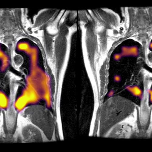 New imaging tech finds hidden lung damage in long COVID patients