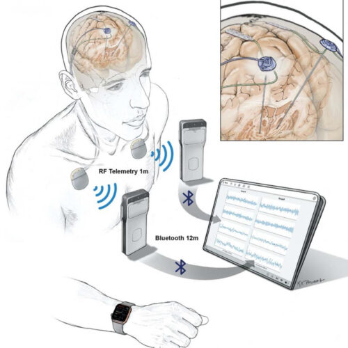 Researchers wirelessly record human brain activity during normal life activities