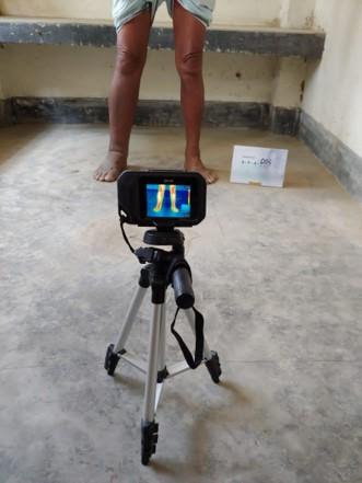 Infrared imaging to detect lymphatic filariasis