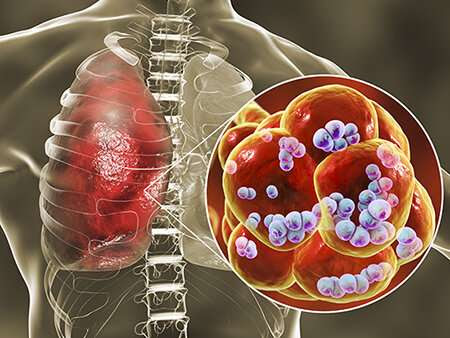 S. pneumoniae sticks to dying lung cells, worsening secondary infection following flu