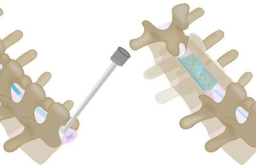 Inflatable, shape-changing spinal implants could help treat severe pain