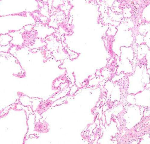 Is elevated level of lung protein an early predictor for COPD?