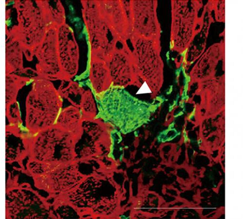 Converting scar tissue to heart muscle after a heart attack