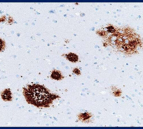 Study says failure to rid amyloid beta protein from brain may lead to Alzheimer’s disease