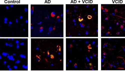 Forget me not: Novel target shows promise in treating Alzheimer’s and related dementias