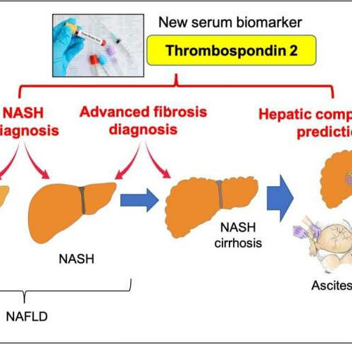 A simple blood test to identify patients at risk of nonalcoholic fatty liver disease