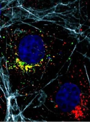 Genetic cause of neurodevelopmental disorder discovered