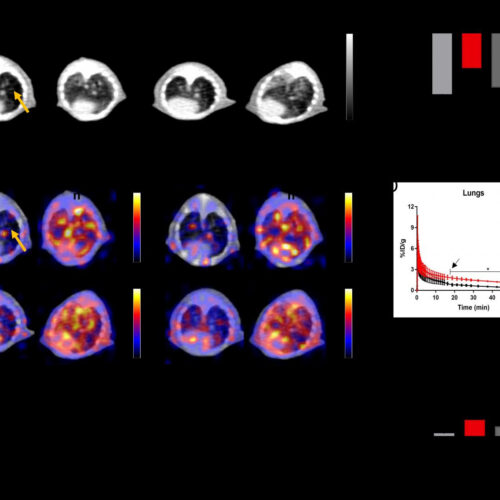 Radiotracer effective for detection and assessment of lung fibrosis