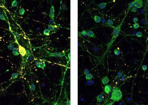 New Alzheimer’s treatment idea targets tau