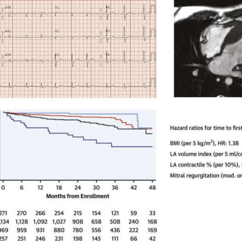 Study IDs risk factors for irregular heartbeats in hypertrophic cardiomyopathy patients