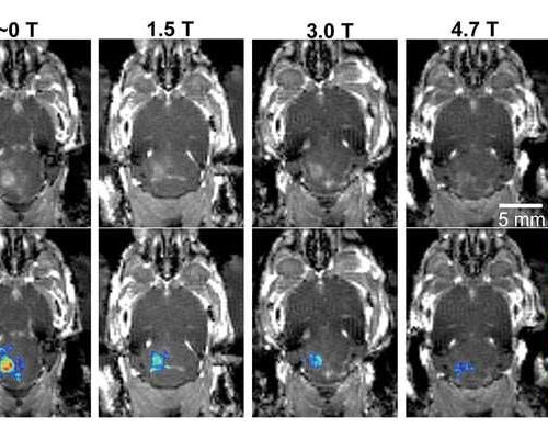 MRI’s magnetic field affects focused ultrasound technology