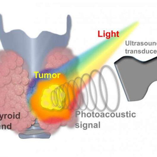 Thyroid cancer now diagnosed with AI photoacoustic/ultrasound imaging