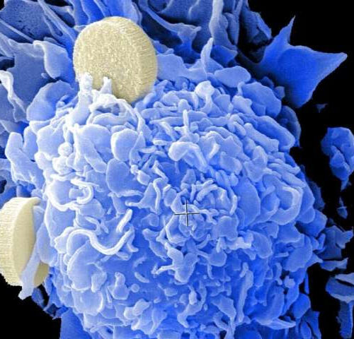 New cancer findings can give wider access to immunotherapy