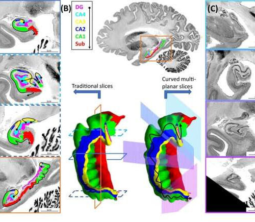 Digitally unfolding the hippocampus to better understand brain disorders