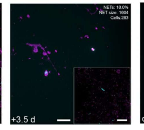 Drug dissolved net-like structures in airways of severely ill COVID-19 patients