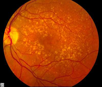 Researchers: HtrA1 augmentation is potential therapy for age-related macular degeneration