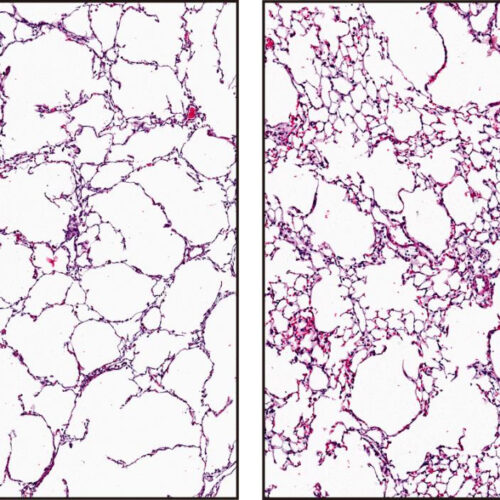 Researchers reverse emphysema in mice by injecting blood vessel wall cells