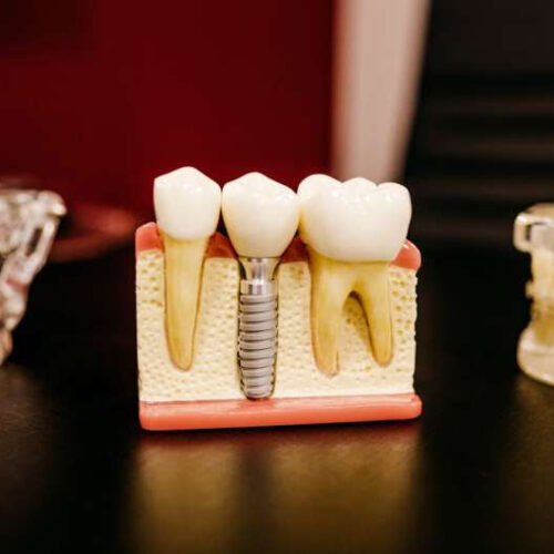 Tooth loss associated with increased cognitive impairment, dementia