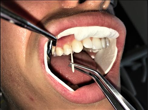 Study reveals new aspects of gingivitis and body’s response