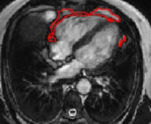 AI predicts diabetes risk by measuring fat around the heart