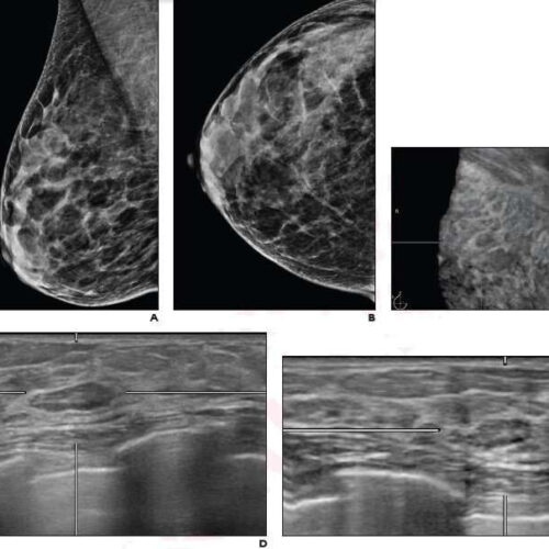 Study supports return to routine screening for BI-RADS lesions on automated whole-breast ultrasound