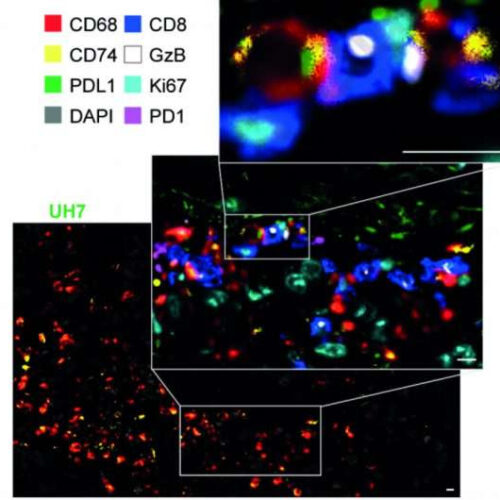 Predicting whether bowel cancers will respond to immunotherapy