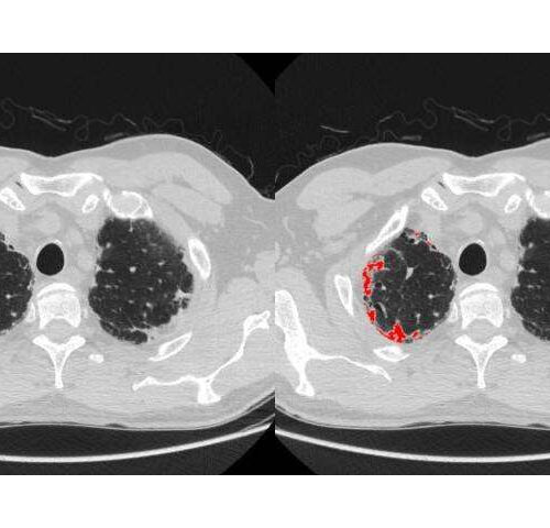 Computerised image analysis identifies new subtype of debilitating lung disease