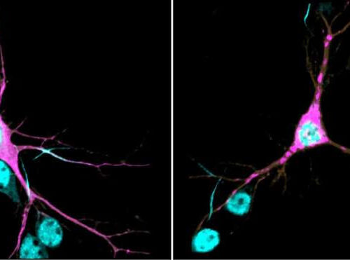 Scientists find genetic cause, underlying mechanisms of new neurodevelopmental syndrome