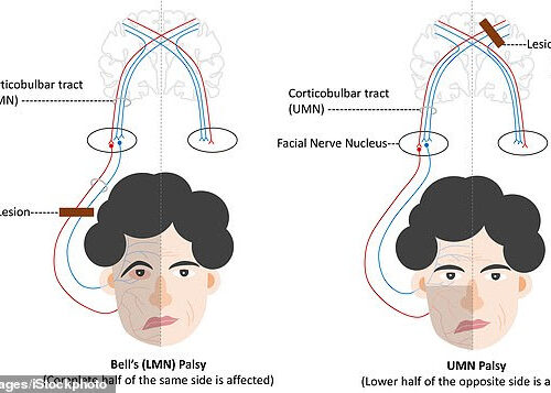 Patients with COVID-19 are SEVEN TIMES more likely to suffer Bell’s palsy