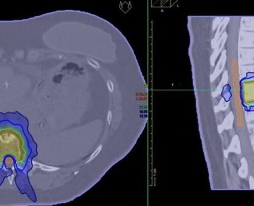 Researchers to investigate new drug to stop incurable prostate cancer spread