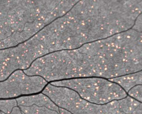 Amyloid deposits in eyes provide a peek at Alzheimer’s disease risk