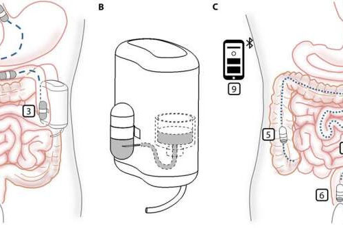 An implantable device for delivering insulin that can be refilled by an ingestible capsule