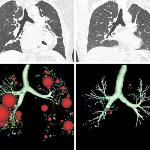 CT scans suggest possible lung destruction in some asthmatics