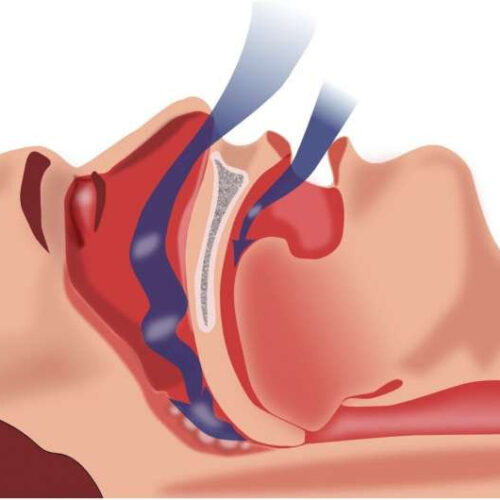 Obstructive sleep apnea is common in kids and may impact blood pressure, heart health