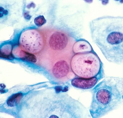 New hypothesis proposed for how chlamydia might increase cancer and ectopic pregnancy risk