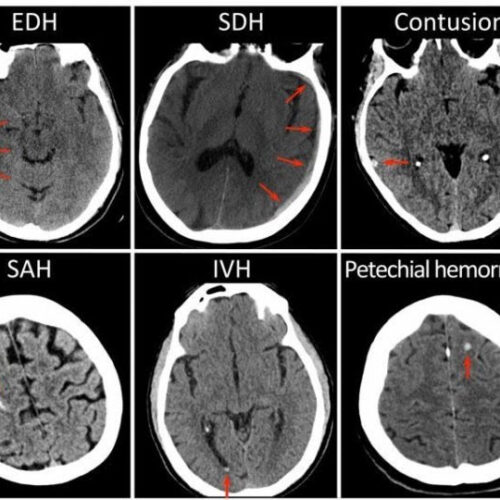 For Concussion Patients, CTs Offer Window into Recovery